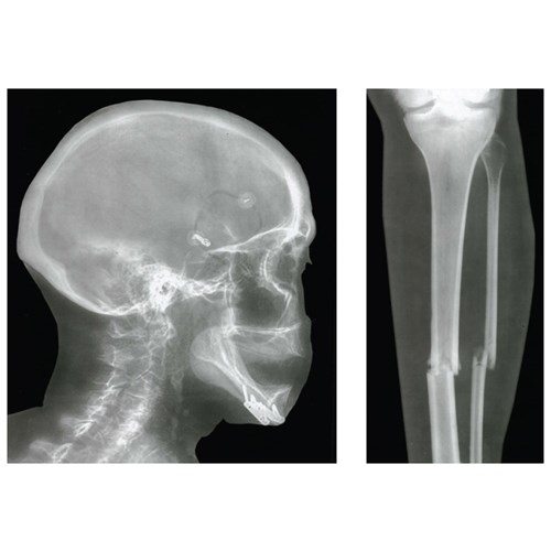 Broken Bones X-Rays - Pack of 15