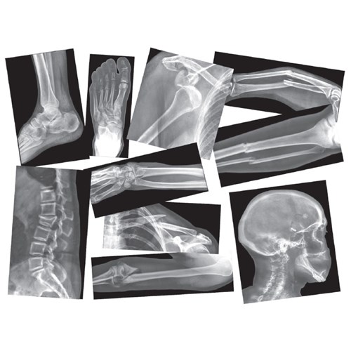 Broken Bones X-Rays - Pack of 15
